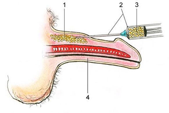 Lipofilling - yağ dokusunun penis şaftına sokulması