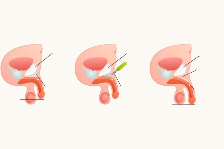 Penisi arttırmak için ligamentotomi