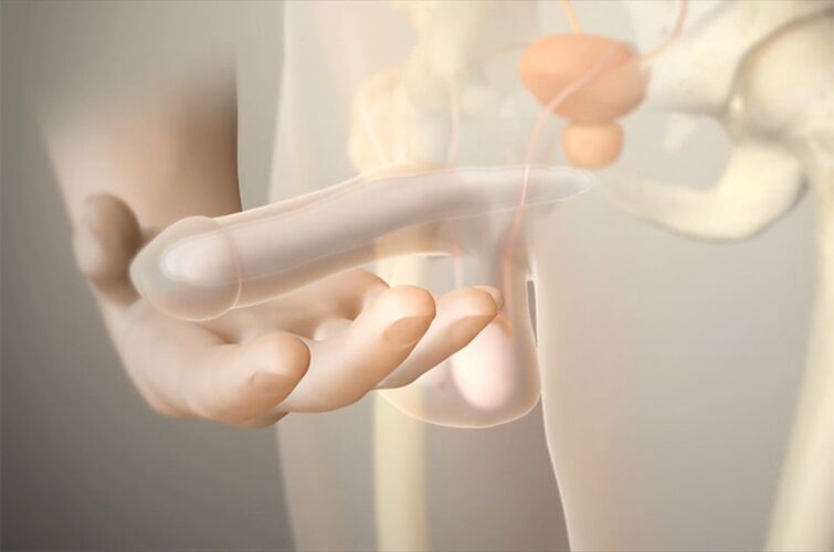 bir üyeyi artırmak için jel implantları