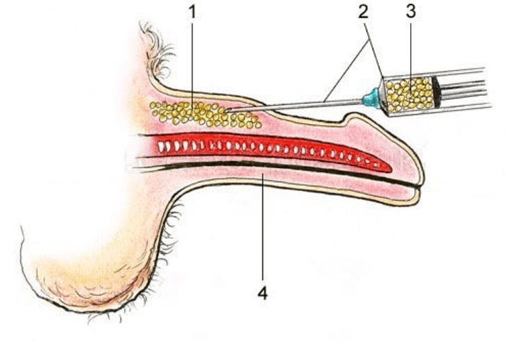 bir üyeyi artırmak için lipofiling