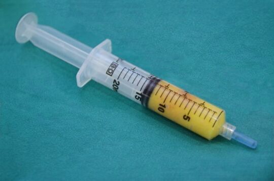 Lipofilling için yağ dokusu içeren şırınga