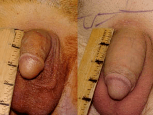 Lipofilling ve jel implantasyonundan önce ve sonra