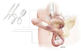 implantların penise yerleştirilmesi